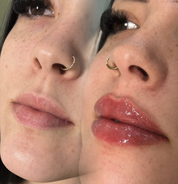 Antes y después — Aumento de labios — hidratación y proyección — Mily La Esthetic