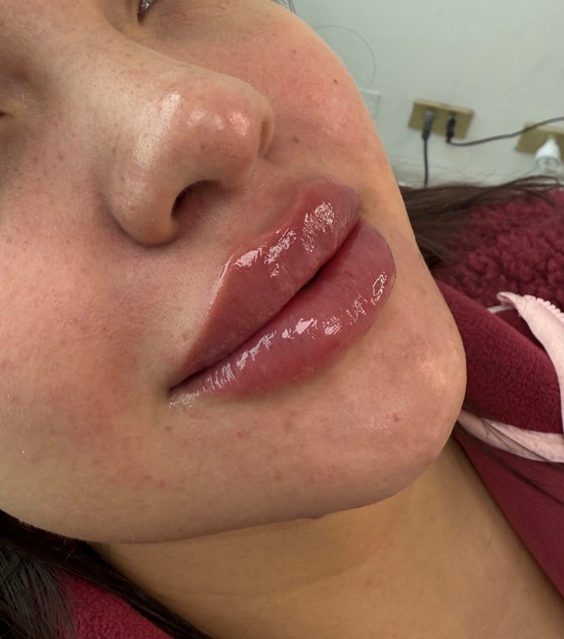 Mily La Esthetic — Aumento de labios