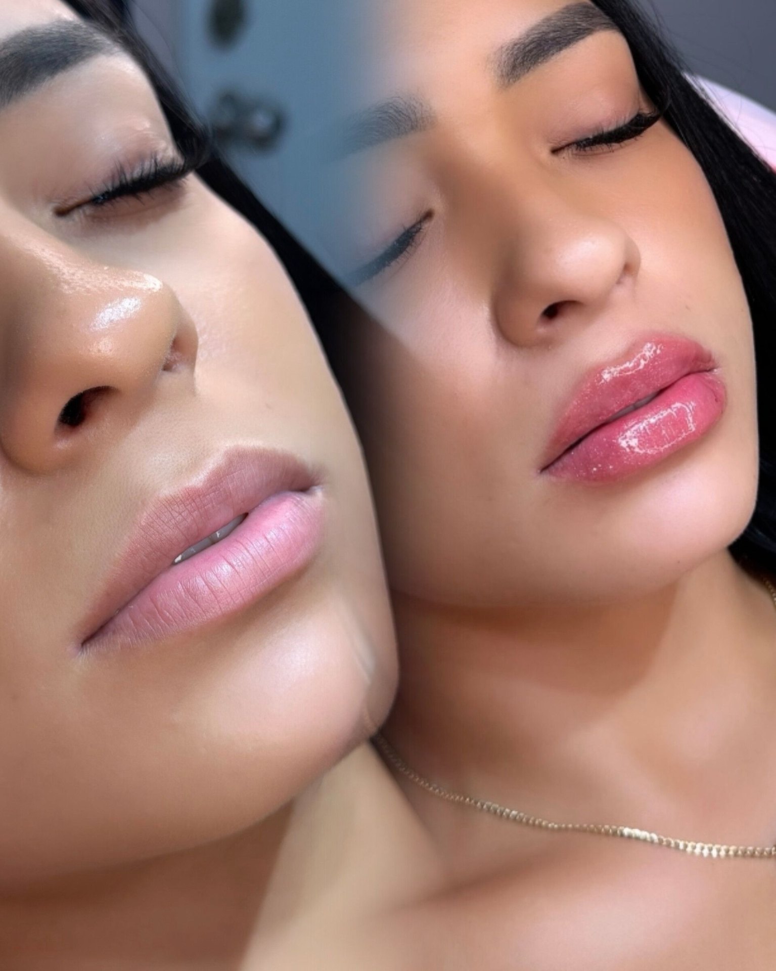 Mily La Esthetic — Labios + Rinomodelación