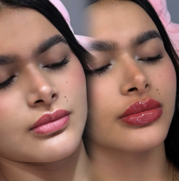 Antes y después — Aumento de labios — definición del contorno — Mily La Esthetic