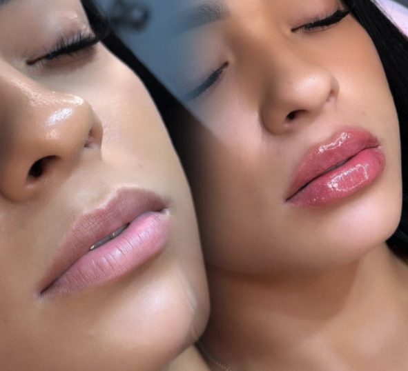 Antes y después — Aumento de labios — resultado glossy — Mily La Esthetic